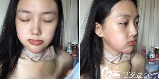 下頜角手術(shù)第3天拔引流管照片 下頜角手術(shù)第3天拔引流管照片