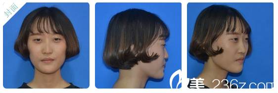 雙眼皮術(shù)前照片 雙眼皮術(shù)前照片