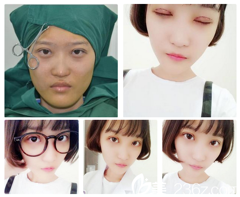 張濤主任雙眼皮術(shù)后第二天 張濤主任雙眼皮術(shù)后第二天