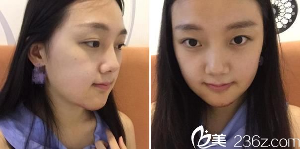 下頜角手術(shù)第4天照片 下頜角手術(shù)第4天照片