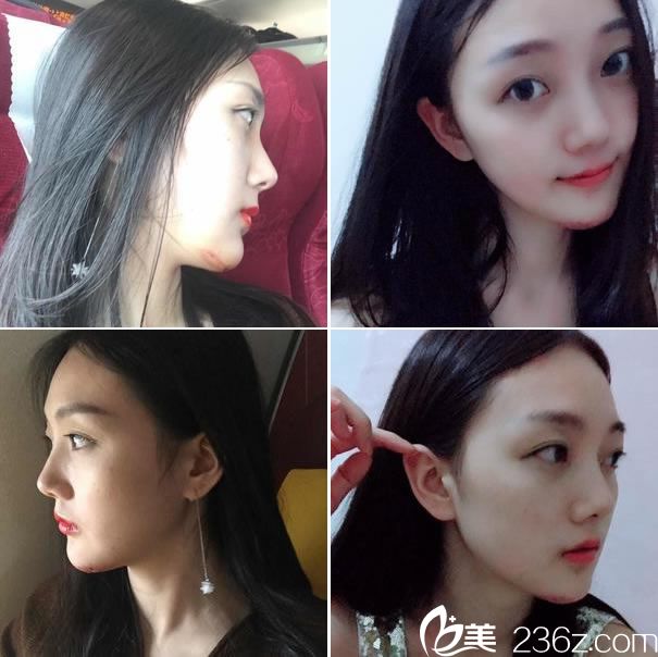 做下頜角手術(shù)第10天的效果 做下頜角手術(shù)第10天的效果