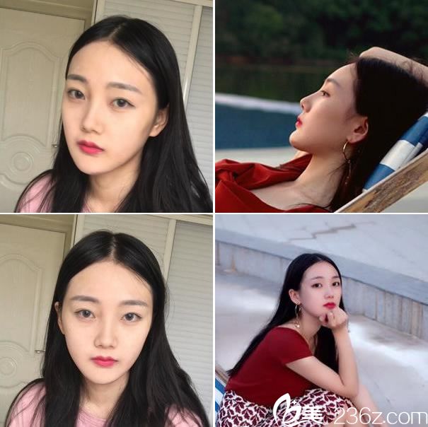 下頜角改臉型手術(shù)15天恢復(fù)圖 下頜角改臉型手術(shù)15天恢復(fù)圖