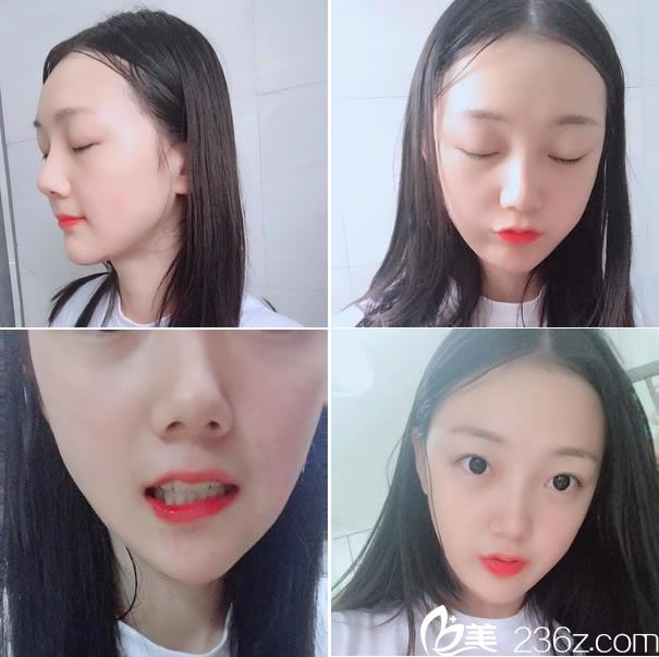 下頜角手術(shù)第35天恢復(fù)效果 下頜角手術(shù)第35天恢復(fù)效果