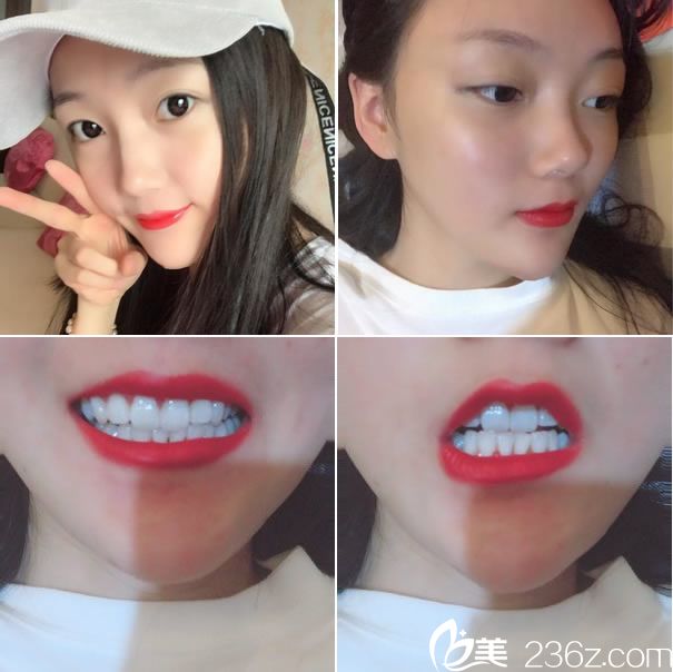 小V臉手術(shù)第55天恢復(fù)圖片 小V臉手術(shù)第55天恢復(fù)圖片