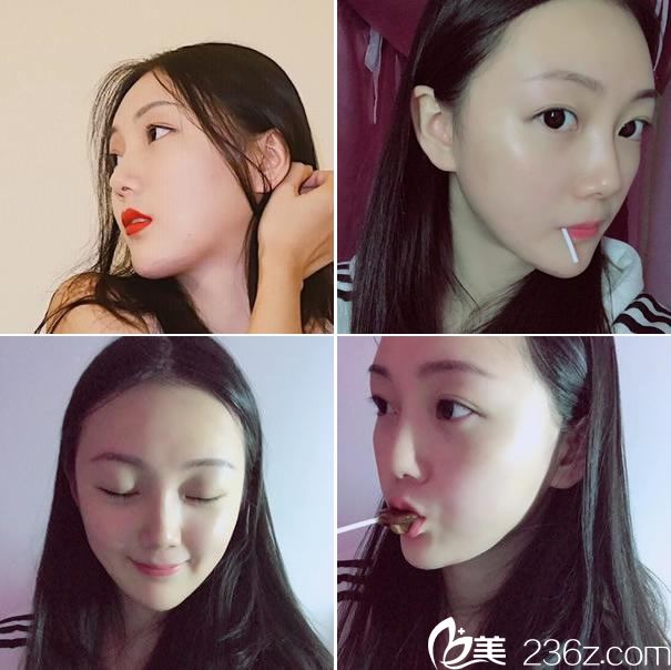 杭州整形唐冬生做下頜角效果 杭州整形唐冬生做下頜角效果