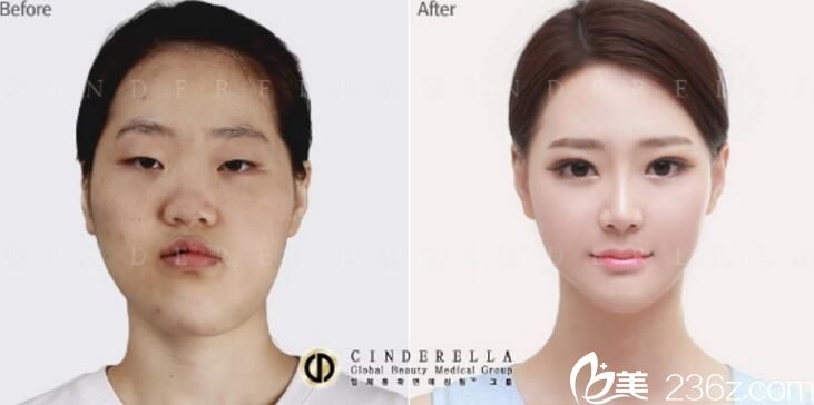 洪淳旻輪廓手術(shù)案例 洪淳旻輪廓手術(shù)案例