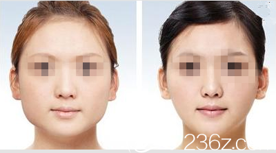 韓國(guó)藝德雅整形外科案例 韓國(guó)藝德雅整形外科案例