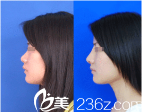 韓國(guó)藝德雅整形外科案例