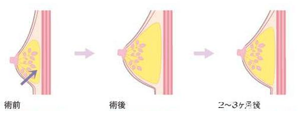 韓國藝德雅整形外科豐胸示意圖