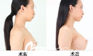 韓國藝德雅整形外科案例