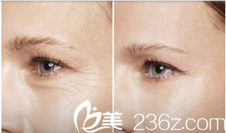 韓國藝德雅整形外科案例