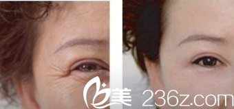 韓國藝德雅整形外科案例