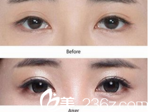 韓國藝德雅整形外科案例