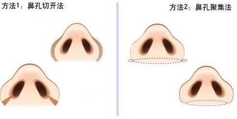 韓國VIEW必嫵整形醫(yī)院鼻翼縮小 韓國VIEW必嫵整形醫(yī)院鼻翼縮小