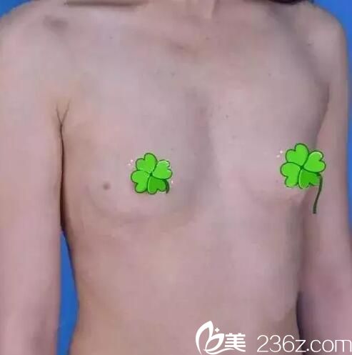 蘭州時光整形美容醫(yī)院賈治蘭術前照片1