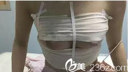 術后第四天隆胸恢復 術后第四天隆胸恢復