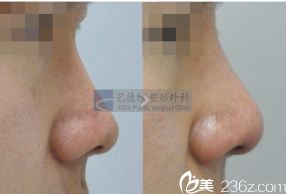 韓國(guó)藝德雅整形外科案例 韓國(guó)藝德雅整形外科案例