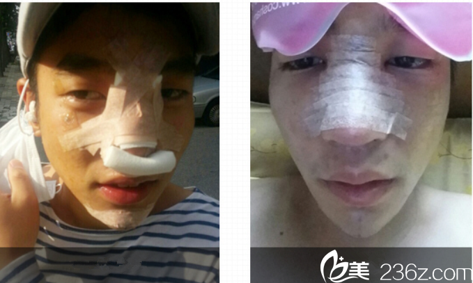 手術(shù)當(dāng)天的我