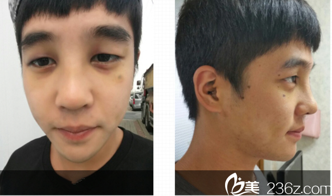 術(shù)后和術(shù)前的對比圖