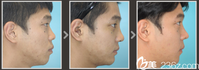 側(cè)面對比圖