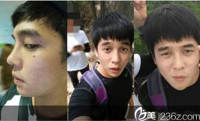 手術(shù)前后對比圖