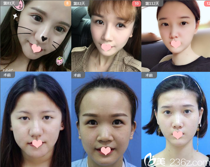 南寧貞韓整形醫(yī)院雙眼皮效果圖