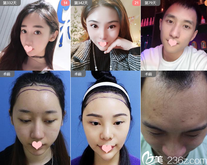 南寧貞韓植發(fā)醫(yī)院發(fā)際線種植效果圖