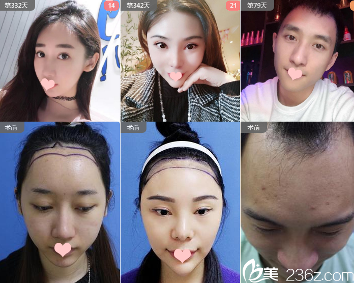 南寧貞韓植發(fā)尹煒能植發(fā)案例對(duì)比圖 南寧貞韓植發(fā)尹煒能植發(fā)案例對(duì)比圖