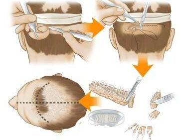 韓國(guó)iWell愛(ài)我整形外科醫(yī)院毛發(fā)移植 韓國(guó)iWell愛(ài)我整形外科醫(yī)院毛發(fā)移植