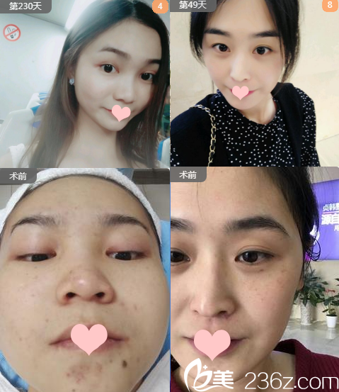 南寧貞韓醫(yī)療美容門診部郝帥美膚案例 南寧貞韓醫(yī)療美容門診部郝帥美膚案例