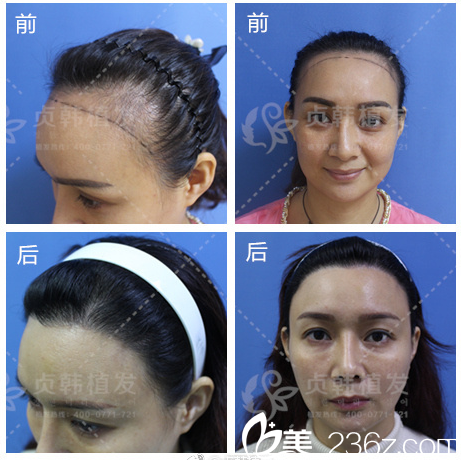 南寧貞韓整形醫(yī)院郝帥植發(fā)案例 南寧貞韓整形醫(yī)院郝帥植發(fā)案例