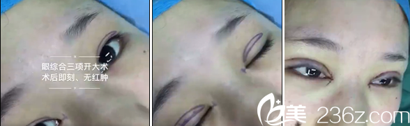 亳州締美李士成眼綜合術(shù)前術(shù)后對(duì)比圖 亳州締美李士成眼綜合術(shù)前術(shù)后對(duì)比圖