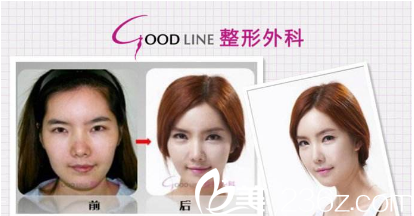 韓國(guó)GOOD-LINE崔德浩整形外科案例