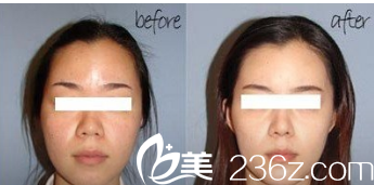 韓國(guó)GOOD LINE崔德浩整形外科案例 韓國(guó)GOOD LINE崔德浩整形外科案例