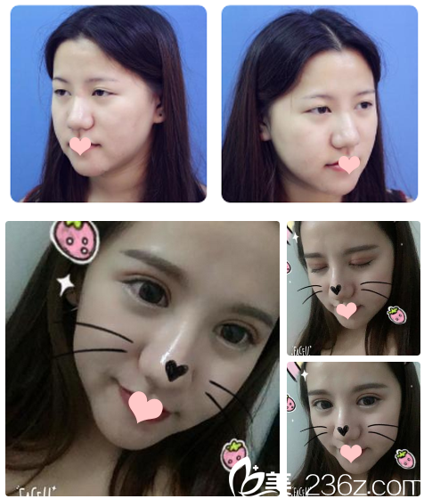 南寧貞韓整形醫(yī)院邵菊麗醫(yī)生雙眼皮案例 南寧貞韓整形醫(yī)院邵菊麗醫(yī)生雙眼皮案例