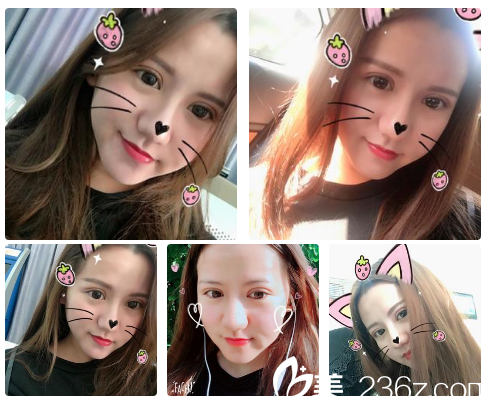 在南寧貞韓整形醫(yī)院做雙眼皮2個月自拍 在南寧貞韓整形醫(yī)院做雙眼皮2個月自拍