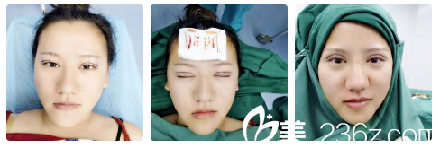 南寧貞韓邵菊麗主任雙眼皮即刻效果 南寧貞韓邵菊麗主任雙眼皮即刻效果