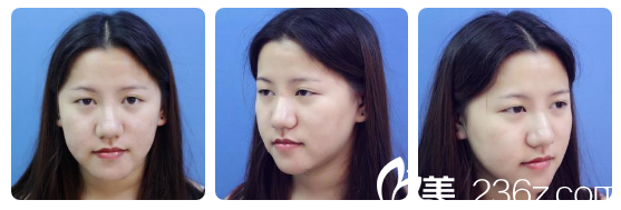 雙眼皮術前照片 雙眼皮術前照片