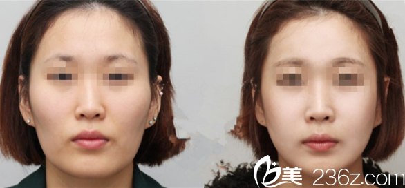 韓國GOOD LINE崔德浩整形外科案例