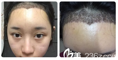 在南寧貞韓做發(fā)際線種植5天結(jié)痂圖 在南寧貞韓做發(fā)際線種植5天結(jié)痂圖