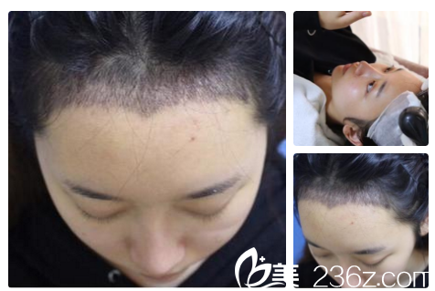 發(fā)際線種植10天清洗痂皮后的樣子 發(fā)際線種植10天清洗痂皮后的樣子