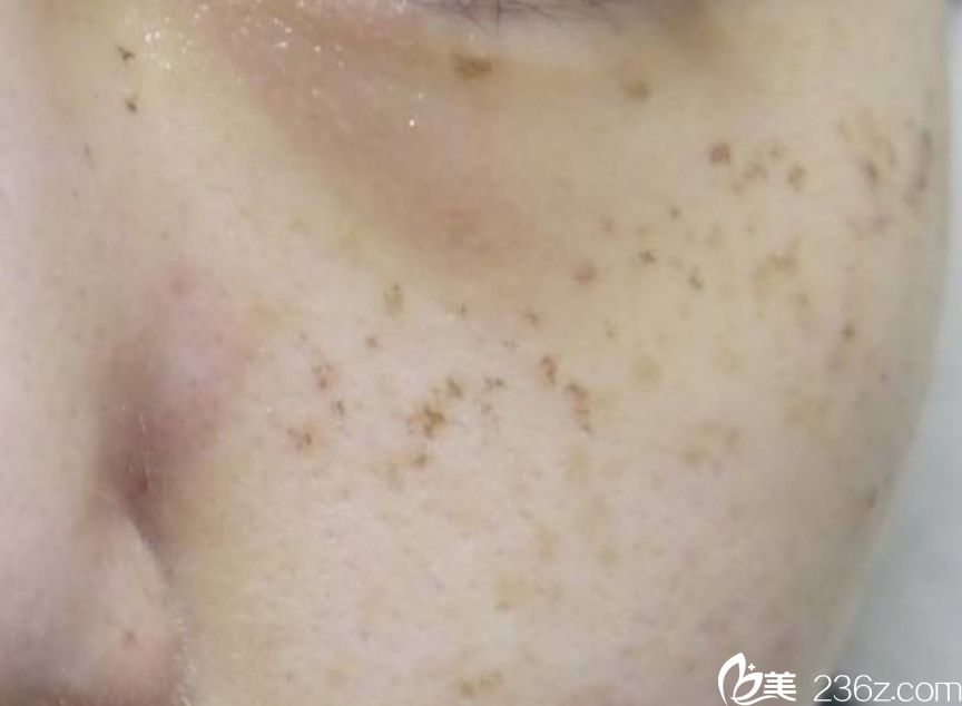 韓國(guó)童顏中心祛斑效果好嗎