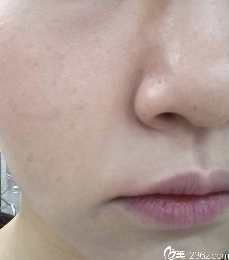 韓國(guó)童顏中心祛斑真人案例對(duì)比圖