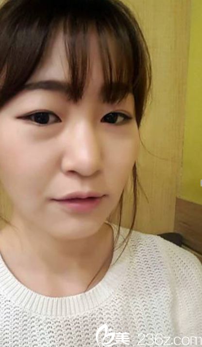 韓國(guó)童顏中心具昭延院長(zhǎng)意大利色素儀器祛斑真人案例