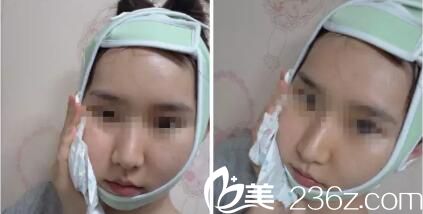 韓國iWell愛我整形外科真人案例術(shù)后第五天 韓國iWell愛我整形外科真人案例術(shù)后第五天