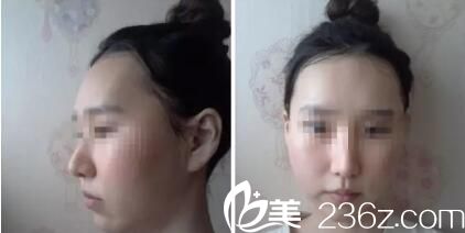 韓國iWell愛我整形外科真人案例術(shù)后14天 韓國iWell愛我整形外科真人案例術(shù)后14天