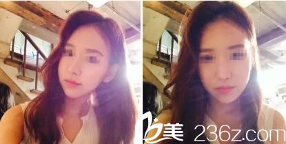   韓國iWell愛我整形外科醫(yī)院樸范鎮(zhèn)院長做顴骨效果怎么樣？顴骨縮小真人案例