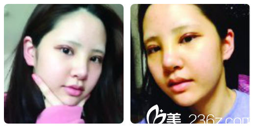 找梁志為做完眼睛鼻子半個月自拍 找梁志為做完眼睛鼻子半個月自拍