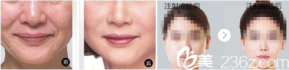 亳州締美邢志平面部年輕化和瘦臉案例 亳州締美邢志平面部年輕化和瘦臉案例