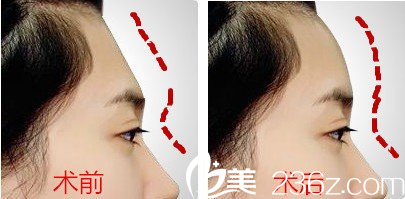 玻尿酸豐額頭不僅填充凹陷還能除皺